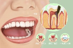 牙齒中間有黑洞，很可能是死髓牙！